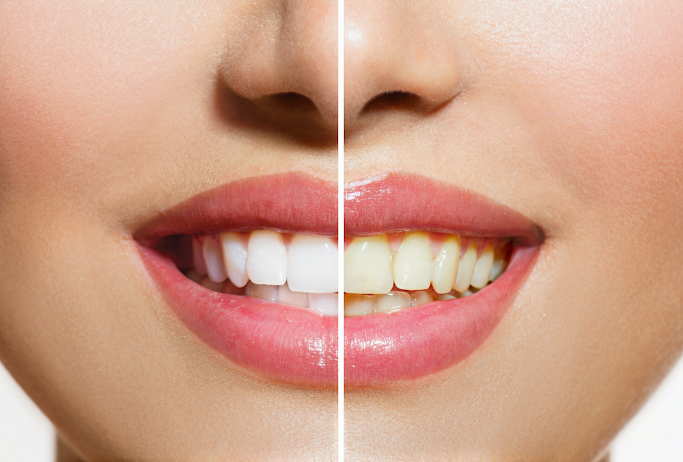 Stained Teeth | Cosmetic Dentist in Benicia
